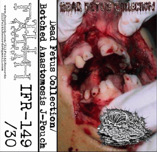 Botched Anastomosis J-Pouch : Dead Fetus Collection - Botched Anastomosis J-Pouch